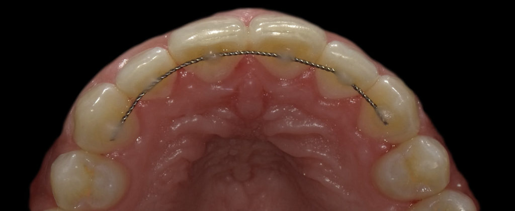 Bild von der Nutzung eines Aligners im Mundraum - Bild vom Gaumen.