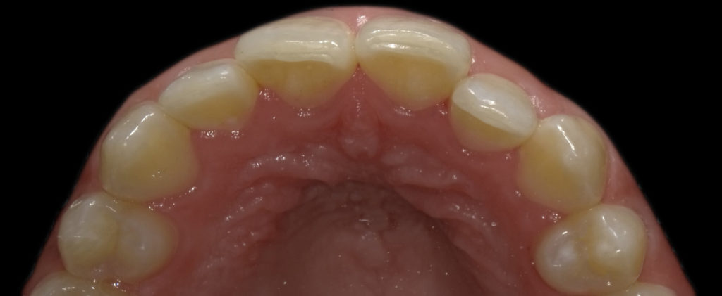 Bild von der Nutzung eines Aligners im Mundraum.